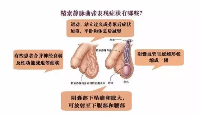 四川省生殖医院第八期健康讲堂：张辉医生谈男性不育之精索静脉曲张