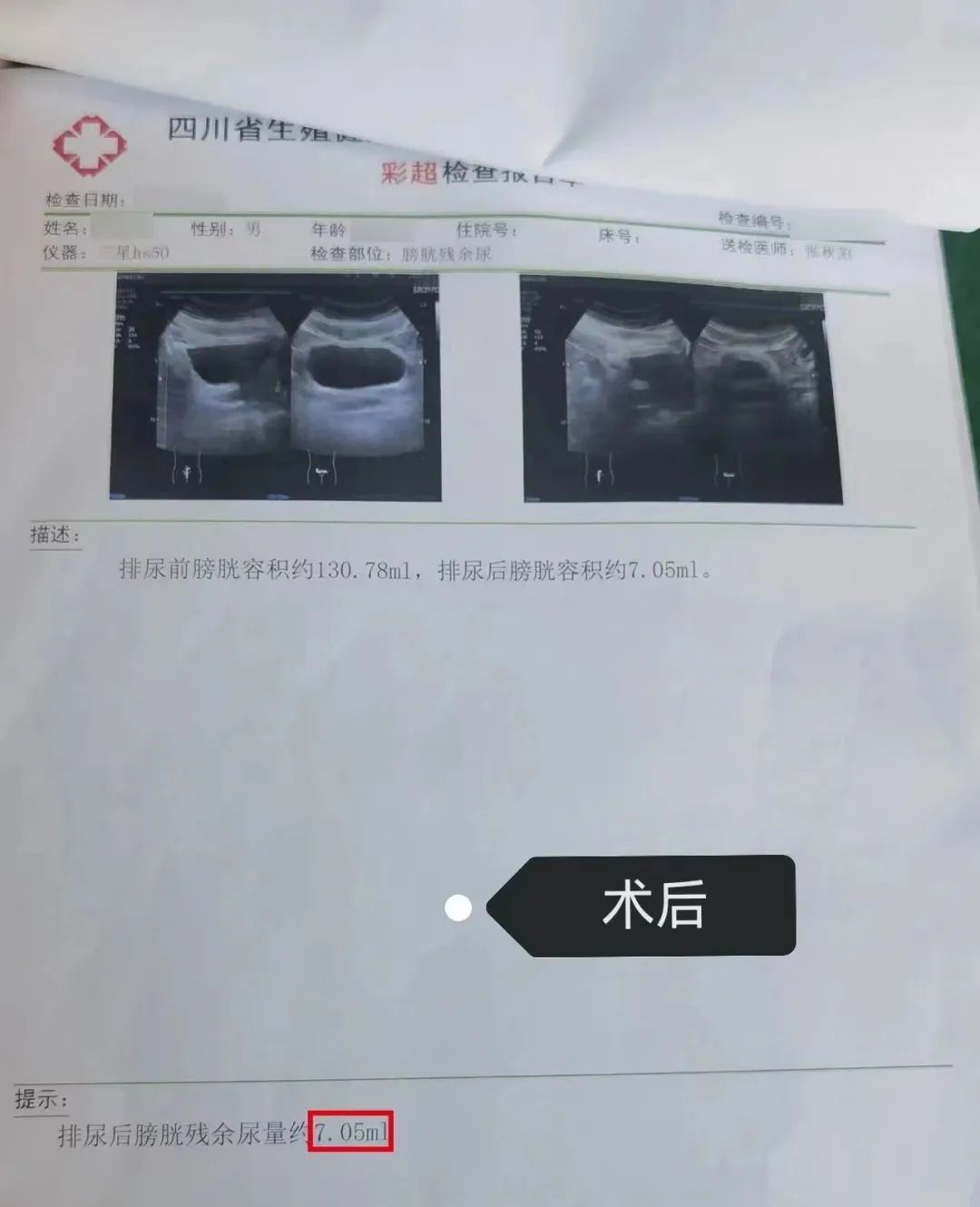 四川省生殖专科医院前列腺增生热蒸汽治疗后